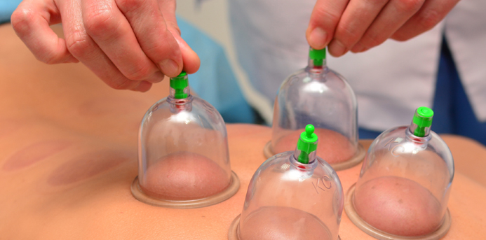 Cupping: What You Need to Know About This Treatment Used By Olympians