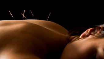 5 Things to Know Before You Try Acupuncture
